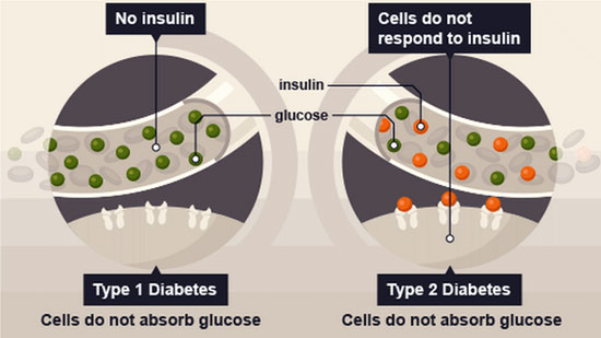 Unlocking the Path to Managing Type 2 Diabetes Effectively