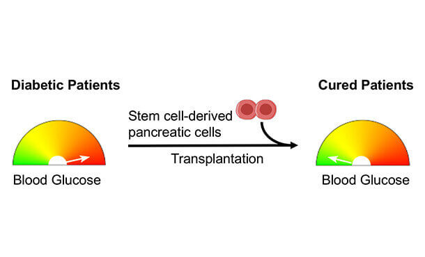 Diabetes Stem Cell Treatment India